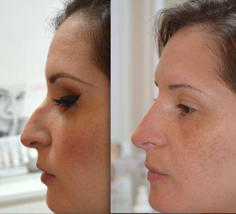 Rhinoplastie Tunisie VIP | Prix Chirurgie nez en Tunisie